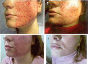 stages of skin recovery after a fractional ablation procedure