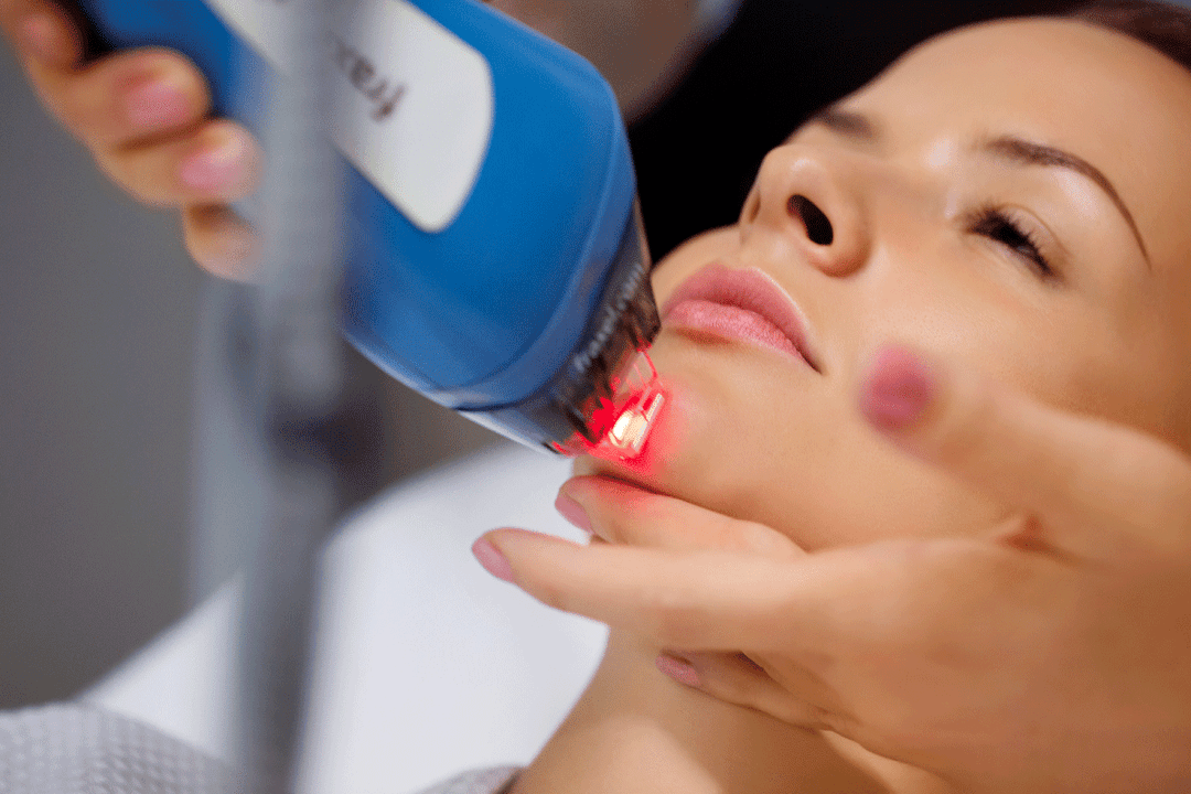 laser rejuvenation of facial skin