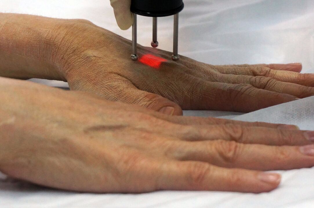 Laser hand rejuvenation with non-ablative method