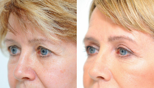 blepharoplasty - before and after