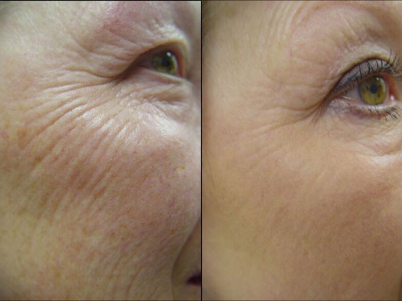 Before and after the laser rejuvenation procedure - significant reduction of wrinkles