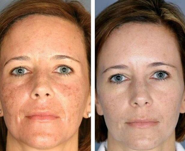 Laser rejuvenation