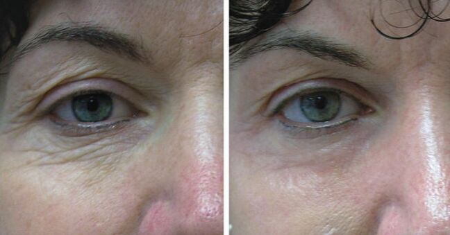 Leather laser around the eyes