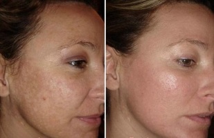 laser rejuvenation of facial skin before and after photos